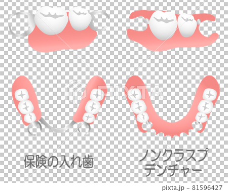 無扣假牙和保險假牙（附文字） 81596427