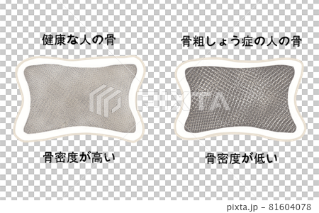 健康な骨と骨粗しょう症の骨の比較イラスト 81604078