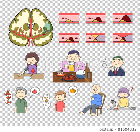アテローム血栓性脳梗塞のイラスト アテローム血栓性脳梗塞のイラスト 81604332