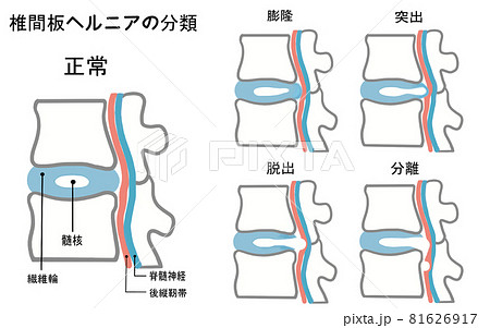 健康な椎間板と椎間板ヘルニアの4つの分類イラスト 81626917