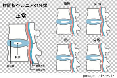 健康な椎間板と椎間板ヘルニアの4つの分類イラスト 81626917