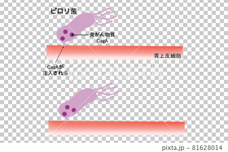 幽門螺桿菌感染導致胃癌的風險說明 81628014