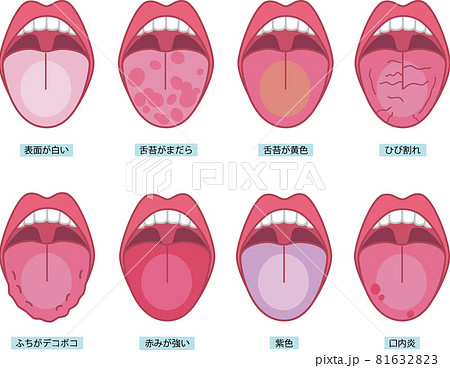 舌の健康状態の種類のイラスト素材