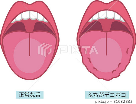舌のイラスト 舌のイラスト 81632832