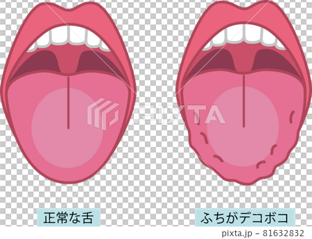 舌のイラスト 舌のイラスト 81632832