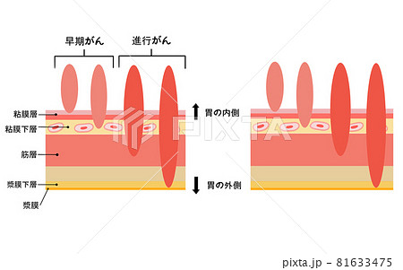 早期がんと進行がんの図解イラストのイラスト素材