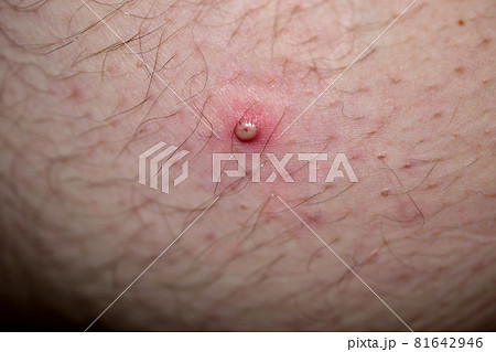 A ripe pimple is visible on human skin. A ripe pimple is visible on human skin. 81642946