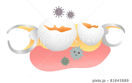汚れた入れ歯(部分入れ歯) 汚れた入れ歯(部分入れ歯) 81643889
