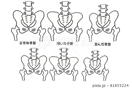 健康な骨盤と歪んだ骨盤の比較イラストのイラスト素材