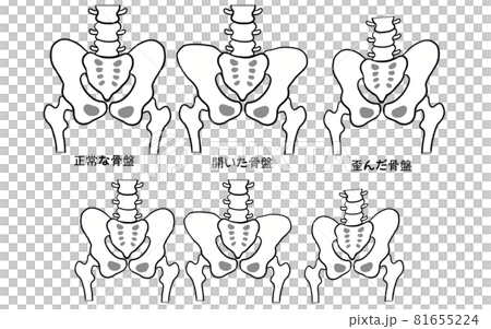 健康な骨盤と歪んだ骨盤の比較イラスト 健康な骨盤と歪んだ骨盤の比較イラスト 81655224