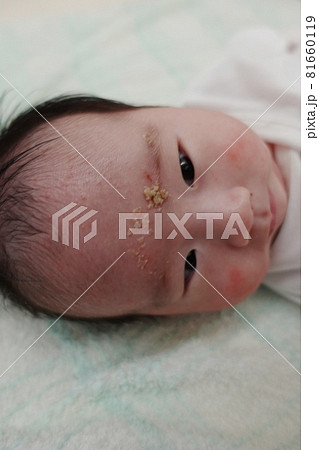 乳児脂漏性湿疹 81660119