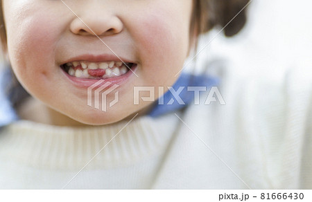 乳歯が抜けた女の子 81666430