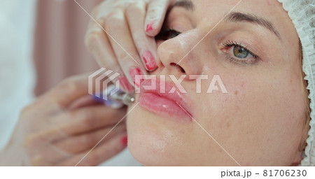 Female doctor, injecting hyaluronic acid into the patient's lips. Procedure for increasing the volume of lips, correction of lips shape. 81706230