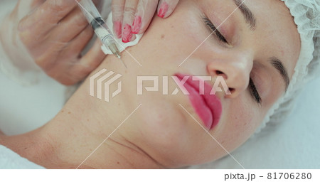 Close-up of a beautician giving an injection into the cheek of a woman. Mesotherapy and face lifting in beauty clinic. Mesotherapy, biorevitalization. Cosmetology. Close-up of a beautician giving an injection into the cheek of a woman. Mesotherapy and face lifting in beauty clinic. Mesotherapy, biorevitalization. Cosmetology. 81706280