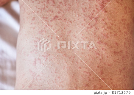 allergic rash on the body of the patient. 5 year old girl. 81712579
