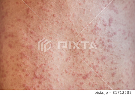 allergic rash on the body of the patient. 5 year old girl. allergic rash on the body of the patient. 5 year old girl. 81712585