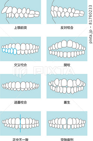 噛み合わせのイラスト 噛み合わせのイラスト 81760233