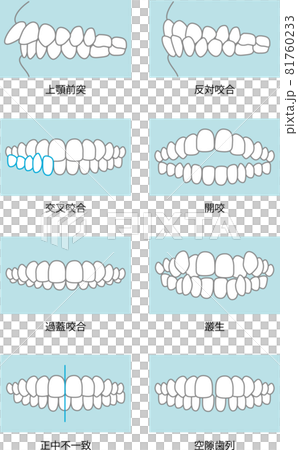 噛み合わせのイラスト 噛み合わせのイラスト 81760233