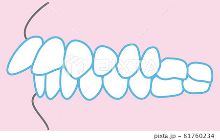 噛み合わせのイラスト 噛み合わせのイラスト 81760234