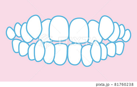 噛み合わせのイラスト 噛み合わせのイラスト 81760238