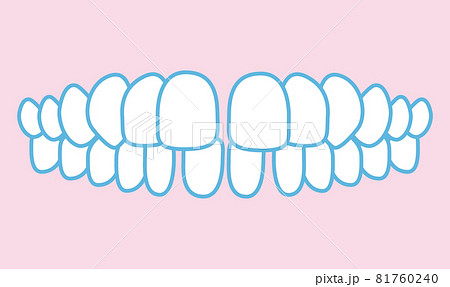 噛み合わせのイラスト 噛み合わせのイラスト 81760240