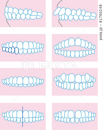 噛み合わせのイラスト 噛み合わせのイラスト 81760248