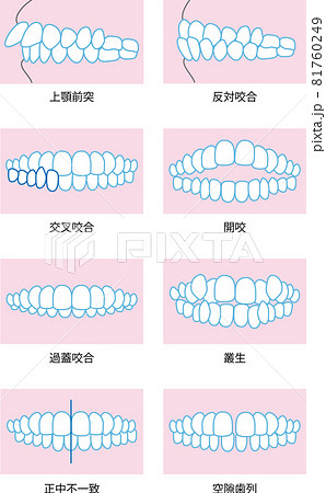 噛み合わせのイラスト 81760249