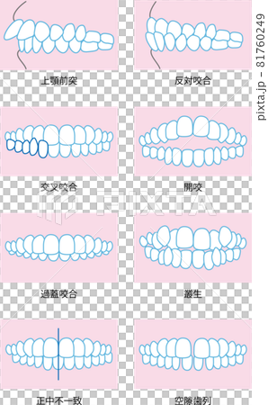 噛み合わせのイラスト 81760249