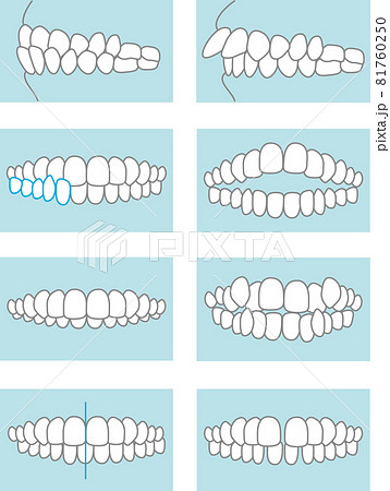 噛み合わせのイラスト 81760250