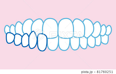 噛み合わせのイラスト 81760251