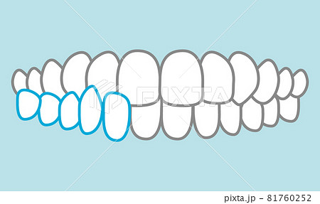 噛み合わせのイラスト 81760252
