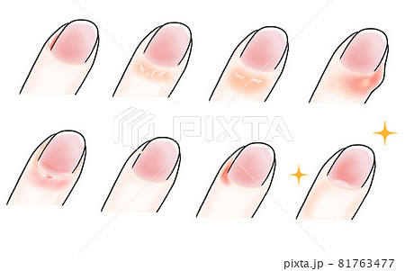 乾燥で荒れた指のイラスト 乾燥で荒れた指のイラスト 81763477