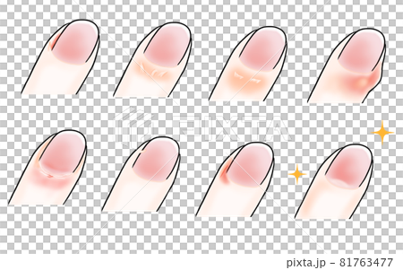 乾燥で荒れた指のイラスト 乾燥で荒れた指のイラスト 81763477