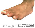 足の小指の爪が割れた画像 81778896