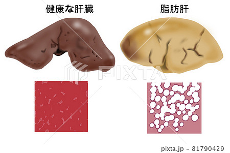 健康な肝臓と脂肪肝の比較イラスト 健康な肝臓と脂肪肝の比較イラスト 81790429
