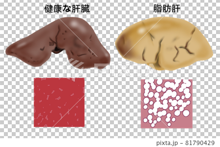 健康肝臟與脂肪肝比較圖 健康肝臟與脂肪肝比較圖 81790429