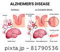 Alzheimer disease and changes in the brain 81790536