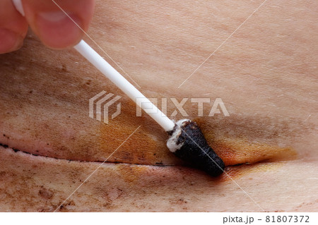 Subcuticular suture surface disinfection with tincture of iodine 81807372