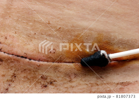 Suture disinfection Suture disinfection 81807373