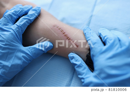 Doctor surgeon in protective medical gloves examining scar on patient hand closeup Doctor surgeon in protective medical gloves examining scar on patient hand closeup 81810006