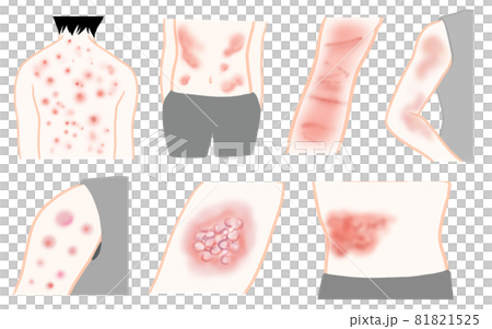 湿疹、疱疹、アトピー　症例7つのイラスト 81821525
