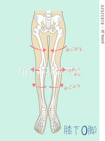 膝下のO脚の骨格 81832020