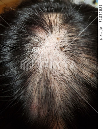 産毛が出てきた円形脱毛症 産毛が出てきた円形脱毛症 81832681