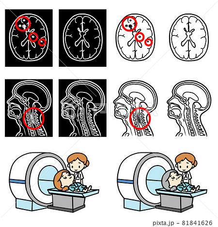 MRI検査を受ける人のイラスト。多発性硬化症の病変。 MRI検査を受ける人のイラスト。多発性硬化症の病変。 81841626