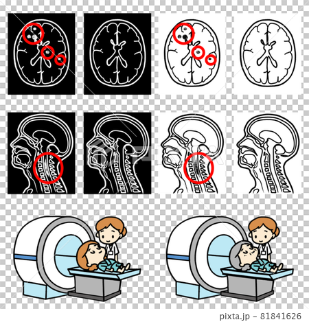 MRI検査を受ける人のイラスト。多発性硬化症の病変。 MRI検査を受ける人のイラスト。多発性硬化症の病変。 81841626