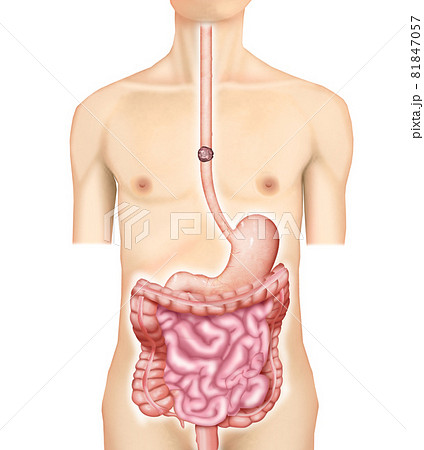 イラスト素材:食道がん・胃管・上行結腸・再建術001(リアル) イラスト素材:食道がん・胃管・上行結腸・再建術001(リアル) 81847057