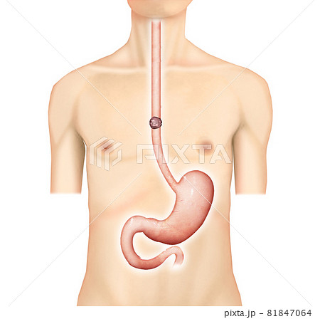 イラスト素材 食道がん 胃管 再建術003 リアル のイラスト素材