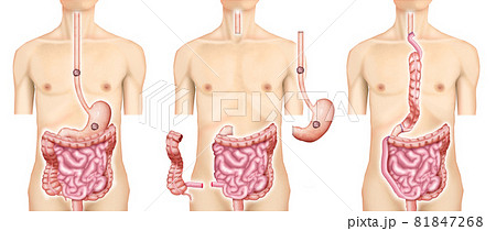 イラスト素材：食道がん・上行結腸・再建術 81847268