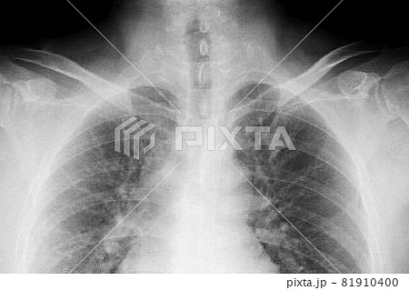 胸のレントゲン 81910400