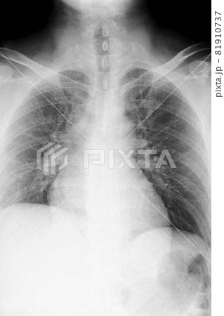 胸のレントゲン 81910737